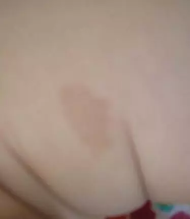 左小腿上有胎记的人代表什么意思(1)