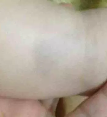左小腿上有胎记的人代表什么意思(2)