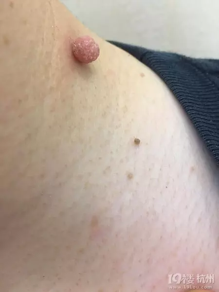 男生背上有个瘊子的人命运怎么样啊(1)