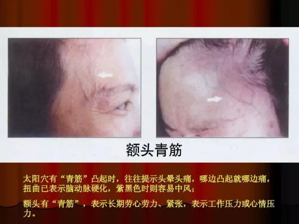 额头中心有一条凸起的线代表什么命运呢(1)