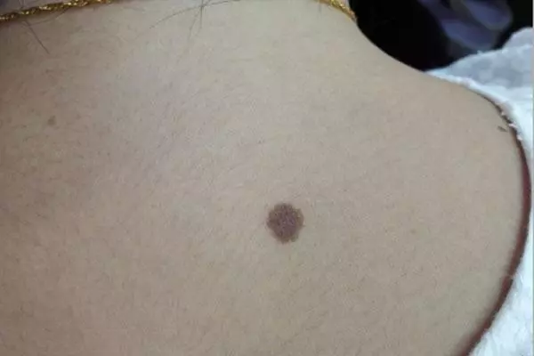 痦子和痣的区别脸上的痣怎么点掉(2)