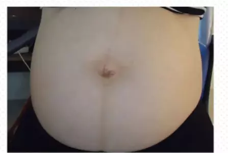 女人肚子上有两条竖线代表什么命运图解(8)