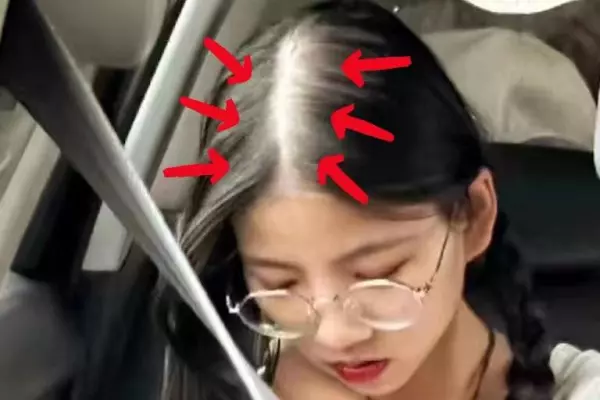 头顶头发稀少,能看见头皮了,怎么办啊(1)