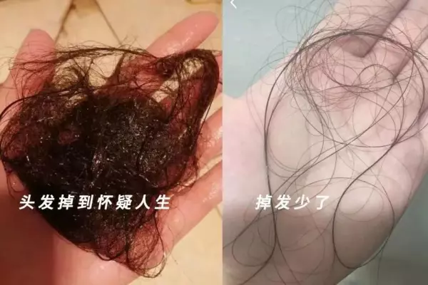头顶头发稀少,能看见头皮了,怎么办啊(3)