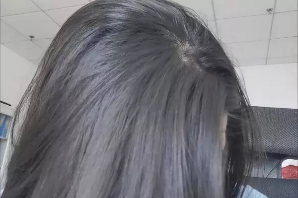 头顶头发稀少,能看见头皮了,怎么办啊(4)