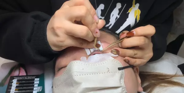 一个眼睛双一个眼睛单是怎么回事(3)