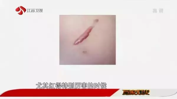 脸上的疤痕比其他部位的容易恢复吗(10)