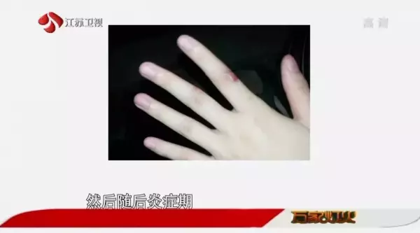 脸上的疤痕比其他部位的容易恢复吗(2)
