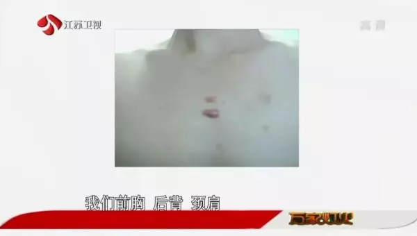 脸上的疤痕比其他部位的容易恢复吗(5)
