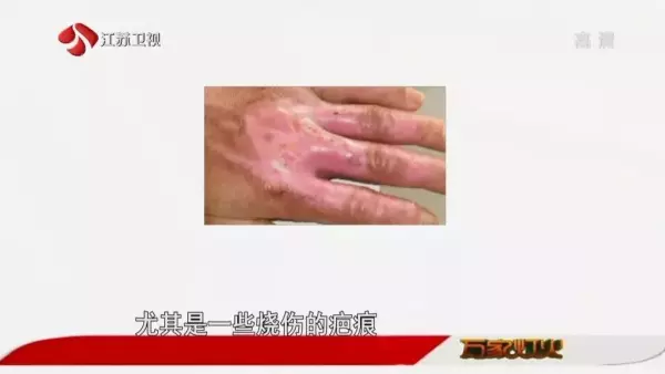 脸上的疤痕比其他部位的容易恢复吗(8)