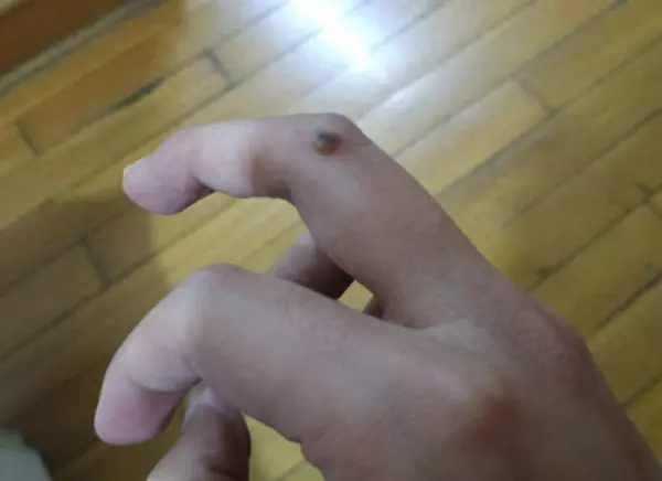大腿内侧长个瘊子,可能是什么癌(1)