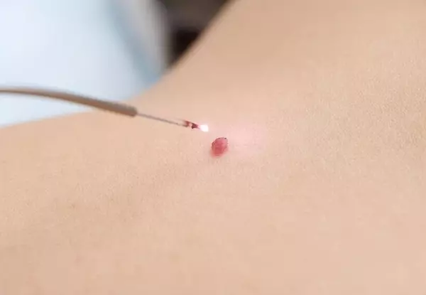大腿内侧长个瘊子,可能是什么癌(4)