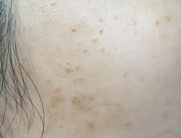 大腿内侧长个瘊子,可能是什么癌(5)