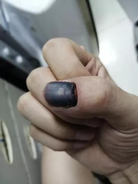 指甲盖掉了重新长出来是什么样子(2)