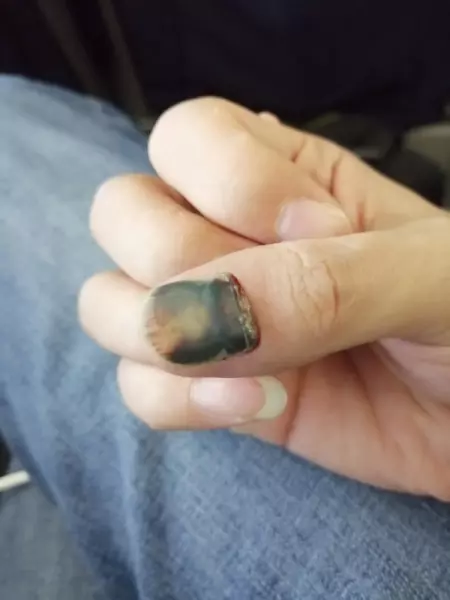 指甲盖掉了重新长出来是什么样子(3)