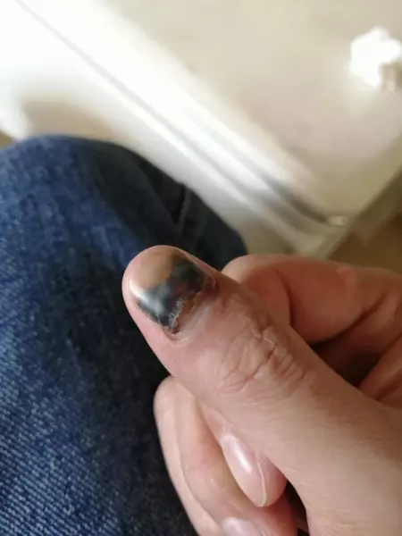 指甲盖掉了重新长出来是什么样子(4)