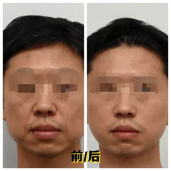 双法令纹面相好不好(2)