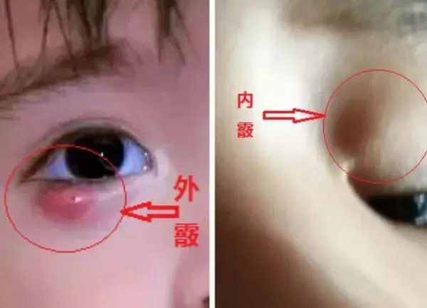 眼泡上长了个小疙瘩是怎么回事(4)