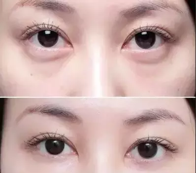 什么是卧蚕与眼袋的区别(2)