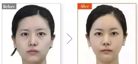 什么是卧蚕与眼袋的区别(3)