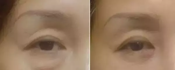 什么是卧蚕与眼袋的区别(5)