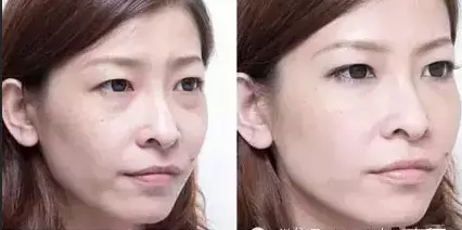 什么是卧蚕与眼袋的区别(6)