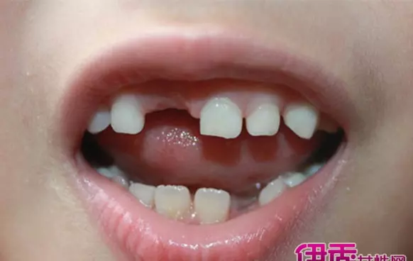 女人梦到门牙掉了两颗是什么意思周公解梦(1)